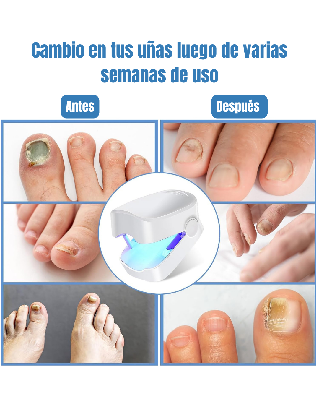 Lámpara Anti-Hongos para Uñas